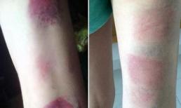 Vụ cô giáo dùng thước đánh 22 học sinh bầm tím: Bộ GD&ĐT chỉ đạo xử lý nghiêm