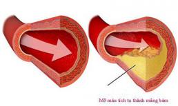 Bệnh mỡ máu cao 'không trừ một ai': Muốn không có bệnh thì nên chú ý 7 điều quan trọng