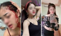 Sở hữu nhan sắc xinh đẹp, cô gái trẻ vẫn bị chồng vũ phu hành hạ đến bầm dập, tơi tả