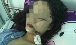 Cô gái xinh đẹp 18 tuổi bị rạch mặt, cổ, tay phải khâu đến 60 mũi