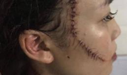 Chị gái thiếu nữ xinh đẹp bị rạch mặt: “Em tôi kêu có thai mà họ vẫn không tha”