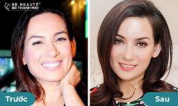 Căng chỉ Collagen thế hệ mới - Công nghệ đảo ngược lão hóa giúp danh ca Phi Nhung tươi trẻ