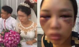 Sự thật bức ảnh cô dâu bị đánh thâm tím mặt mày vì tỏ thái độ “lồi lõm”, không cho chồng hôn ngay trong đám cưới
