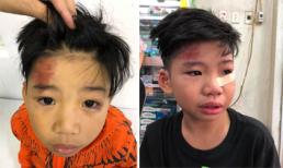 Con trai siêu mẫu Hạ Vy bị tai nạn rách mắt dưới, chấn thương vùng não nhẹ