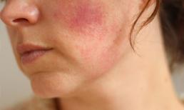 Cảnh báo nguy cơ tổn thương da cực kỳ nghiêm trọng nếu làm đẹp bằng công nghệ giả