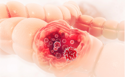 Người làm được 6 việc này sẽ giảm 50% nguy cơ mắc ung thư đại tràng: Hãy sớm áp dụng