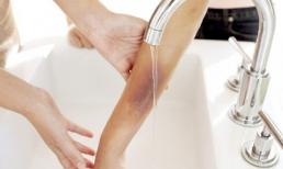 Bỏng axit: Cần sơ cứu nhanh theo các bước này để cứu nạn nhân