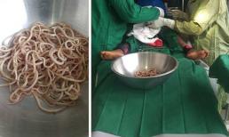 Tưởng bị táo bón, bác sĩ gắp ra từ ruột bé trai 4 tuổi cả chậu giun