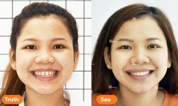 Niềng răng thưa - Quyết định đúng đắn của những nữ sinh tuổi đôi mươi