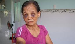 Phẫn nộ con dâu mới sinh 3 tháng đánh mẹ chồng thâm tím mặt rồi khóc lóc xin đừng nói với ai