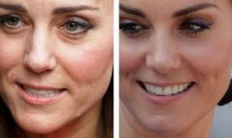 Lo sợ 'nhàu nhĩ' kém cạnh em dâu Meghan, Công nương Kate quyết tâm thẩm mỹ để níu giữ thanh xuân 