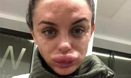 Cô gái người Anh sưng vù môi, suýt hoại tử vì tiêm filler tại nhà