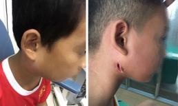 Một bệnh viện ở Nghệ An công bố 3 trẻ nhiễm bệnh Whitmore 'ăn thịt người': Cảnh báo dấu hiệu dễ nhầm lẫn với bệnh quai bị