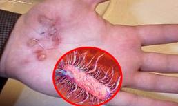 Bác sĩ BV Bạch Mai chỉ rõ 5 cách ngăn chặn sự tấn công của vi khuẩn ăn thịt người