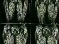 Sán lá gan làm tổ dày đặc 2 chân và 'vùng kín' người phụ nữ do 'nghiện' món ăn mà rất nhiều người Việt cũng mê mẩn