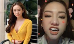 Gặp sự cố ngã gãy răng cửa, Thúy Vi than thở: 'Quê là 1 nhục là 10'