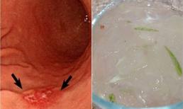 5 loại thảo dược tự nhiên giúp chữa viêm loét dạ dày