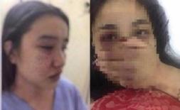 Bộ Y tế yêu cầu xử nghiêm vụ nữ điều dưỡng tố bị bác sĩ gạ tình, đánh đập