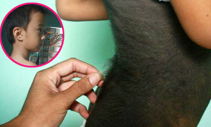 Quảng Nam: Kỳ lạ bé trai khắp người mọc lông đen  