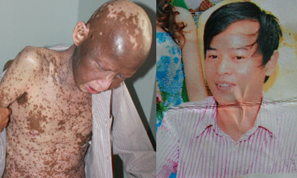 Lời kêu cứu của người đàn ông bị bệnh 'lột da'