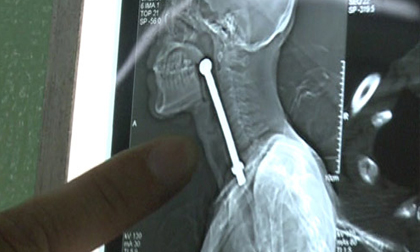 Gọng kính chiếu hậu 15cm mắc trong cổ họng