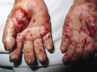 Việt Nam: Phát hiện bé gái mắc bệnh "ma cà rồng"