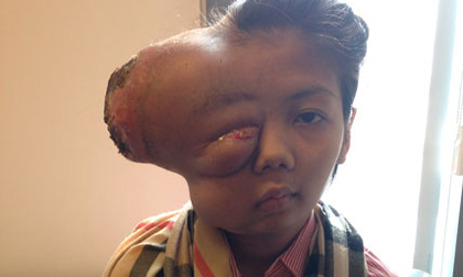 Thiếu nữ bị biến dạng mặt từ khối u bé bằng hạt đậu