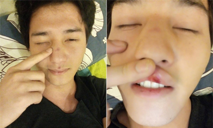 Hotboy Huỳnh Anh mặt mày bầm dập vì tai nạn và bị hôi của