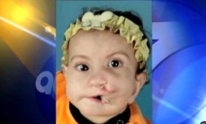 Bé gái có hai... miệng