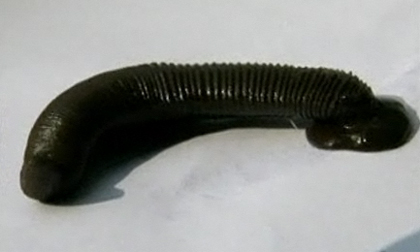 Video: Một thanh niên bị đỉa chui vào cổ họng hút máu