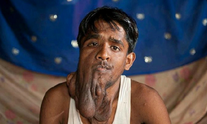 Thêm một người đàn ông "mặt voi" kỳ dị  