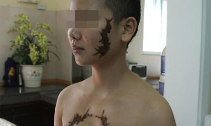 Nỗi đau của gia đình cô gái bị xăm rết