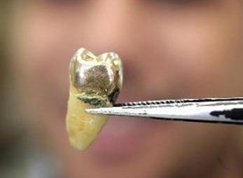 Người Hàn Quốc đua nhau bán răng vàng