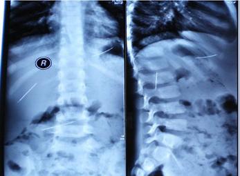 Cậu bé 5 tuổi có ba cây kim khâu trong ổ bụng