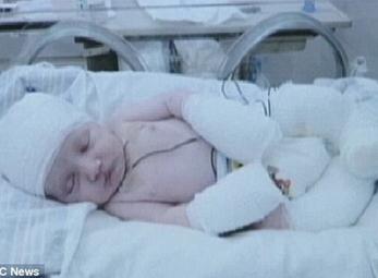 Xót xa bé sơ sinh… không có da 