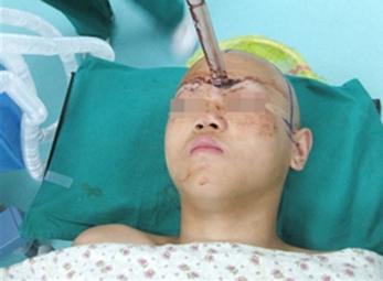 Kiếm đâm giữa trán, may mắn thoát chết 