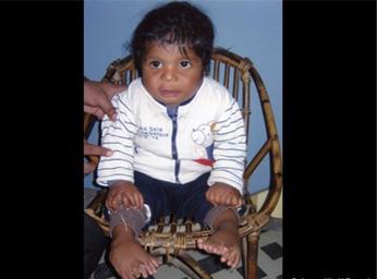 Đứa trẻ có nhiều ngón nhất thế giới 