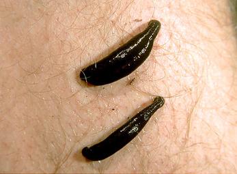 Dùng hàng trăm con đỉa để phẫu thuật khôi phục khuôn mặt