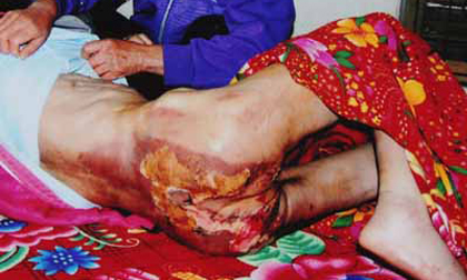 Xót xa người giúp việc kể bị chủ tra tấn