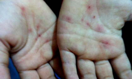 Vụ học sinh bị châm vào tay: Trường kết luận do củ ấu