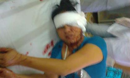 Hà Nội: Một phụ nữ bị chém đứt tai