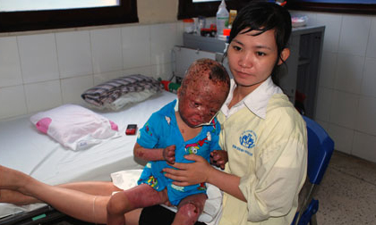 Bé 3 tuổi bị bố đẻ tưới xăng đốt giờ ra sao?