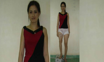 Chuyện cô giáo phẫu thuật kéo dài 12cm chân