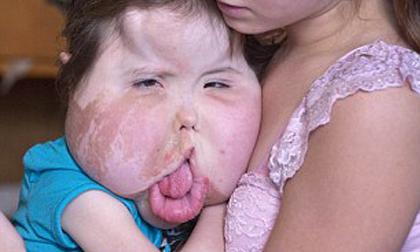 Cô bé có khuôn mặt khổng lồ do mắc bệnh lạ