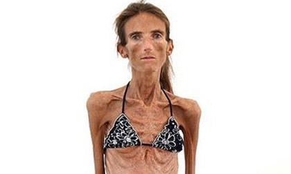 Tâm sự của người phụ nữ gầy nhất thế giới
