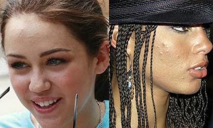 Soi cận những gương mặt lởm chởm mụn của sao