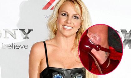 Britney Spears lộ chân lở loét vảy nến "kinh dị"