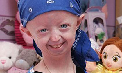 Sốc với hình ảnh cô bé 14 tuổi già như bà lão