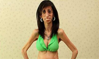 Cô gái siêu gầy với mắt hai màu