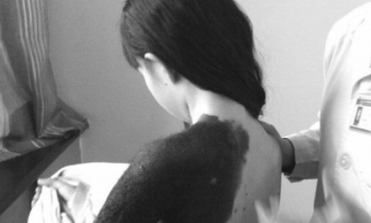 Cô bé có... "nốt ruồi khổng lồ"